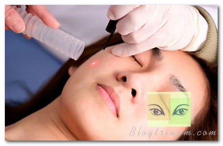 Điều trị nám bằng laser