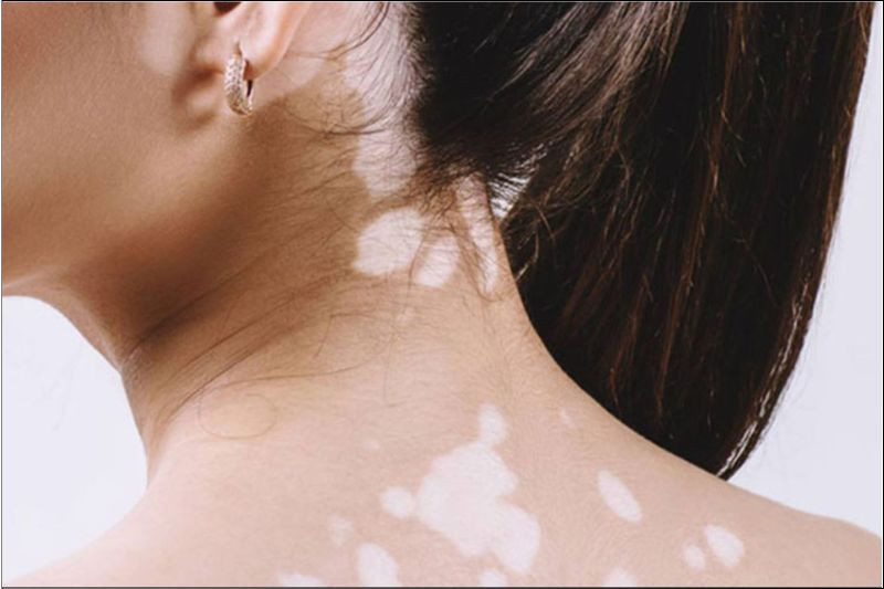 Bệnh lang ben là gì? Nguyên nhân, triệu chứng, cách điều trị