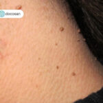 Mụn thịt dư – Top 9 cách trị mụn thịt dư hiệu quả