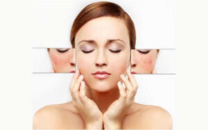 Loại kem trị nám tốt nhất hiện nay chị em khuyên dùng