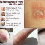 Vitamin E làm dịu da eczema: Bí quyết chăm sóc da nhạy cảm