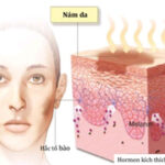 Lạ lẫm với cách trị nám da từ rượu độc và lạ.